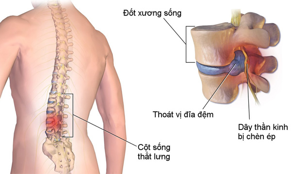 <p style="text-align: center; "><b>Chữa Thoát vị đĩa đệm cột sống</b></p>